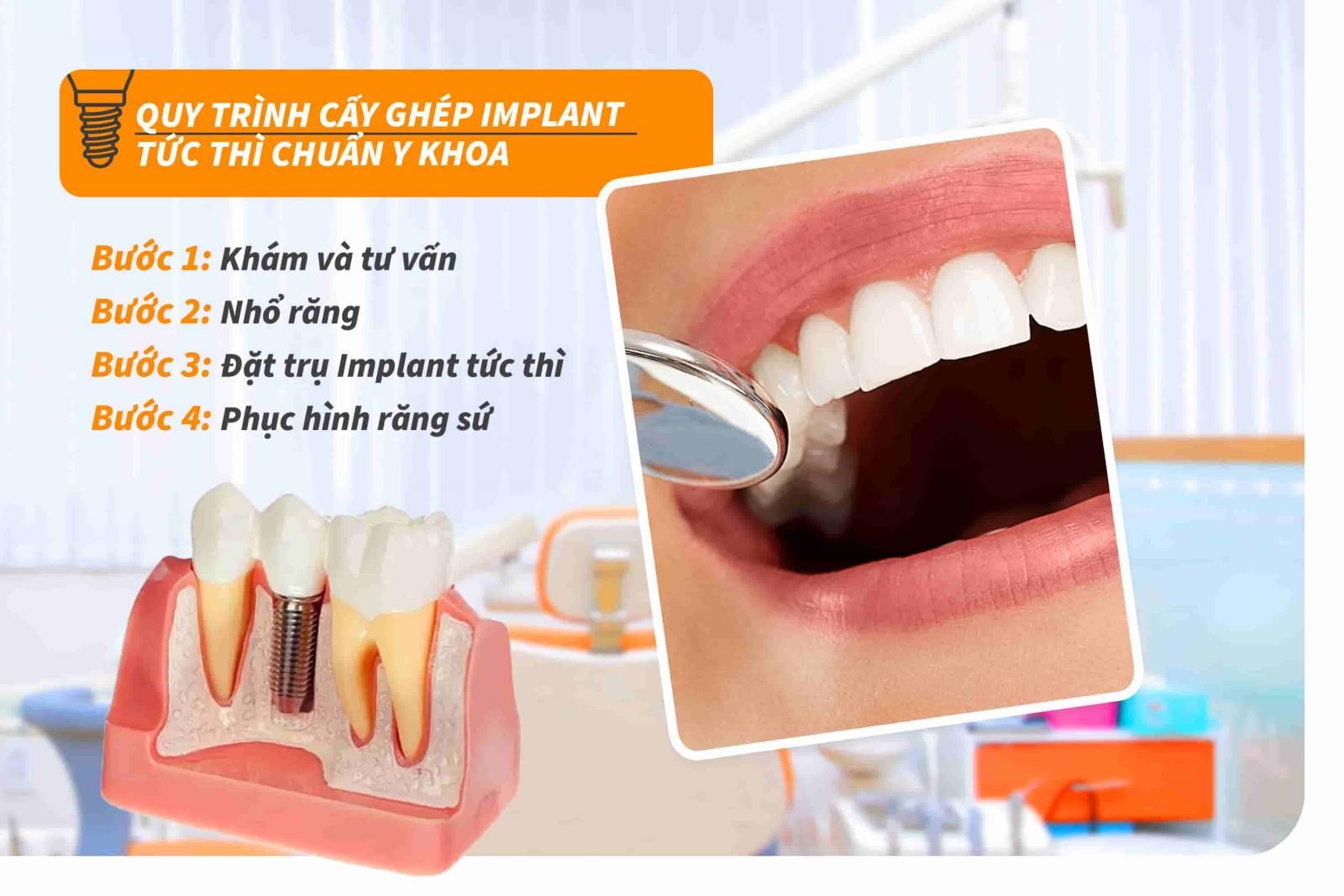 Quy trình cấy ghép Implant tức thì chuẩn Y khoa