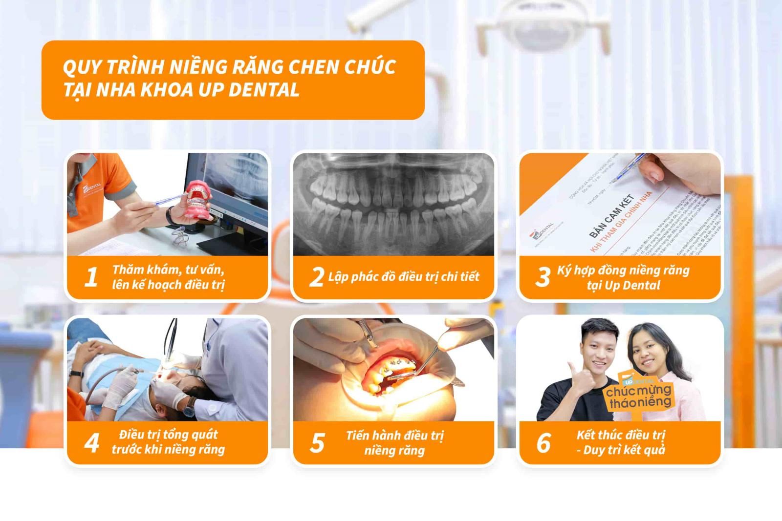 Quy trình niềng răng chen chúc tại nha khoa Up Dental