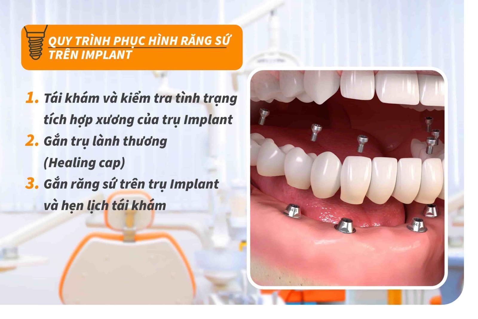 Quy trình phục hình răng sứ trên Implant