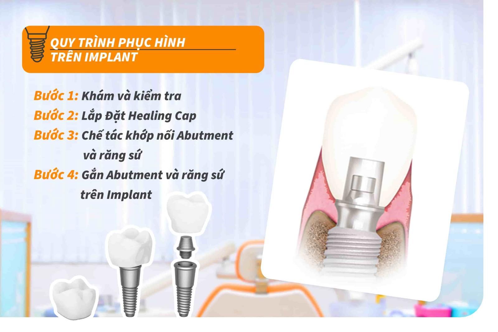 Quy trình phục hình trên Implant