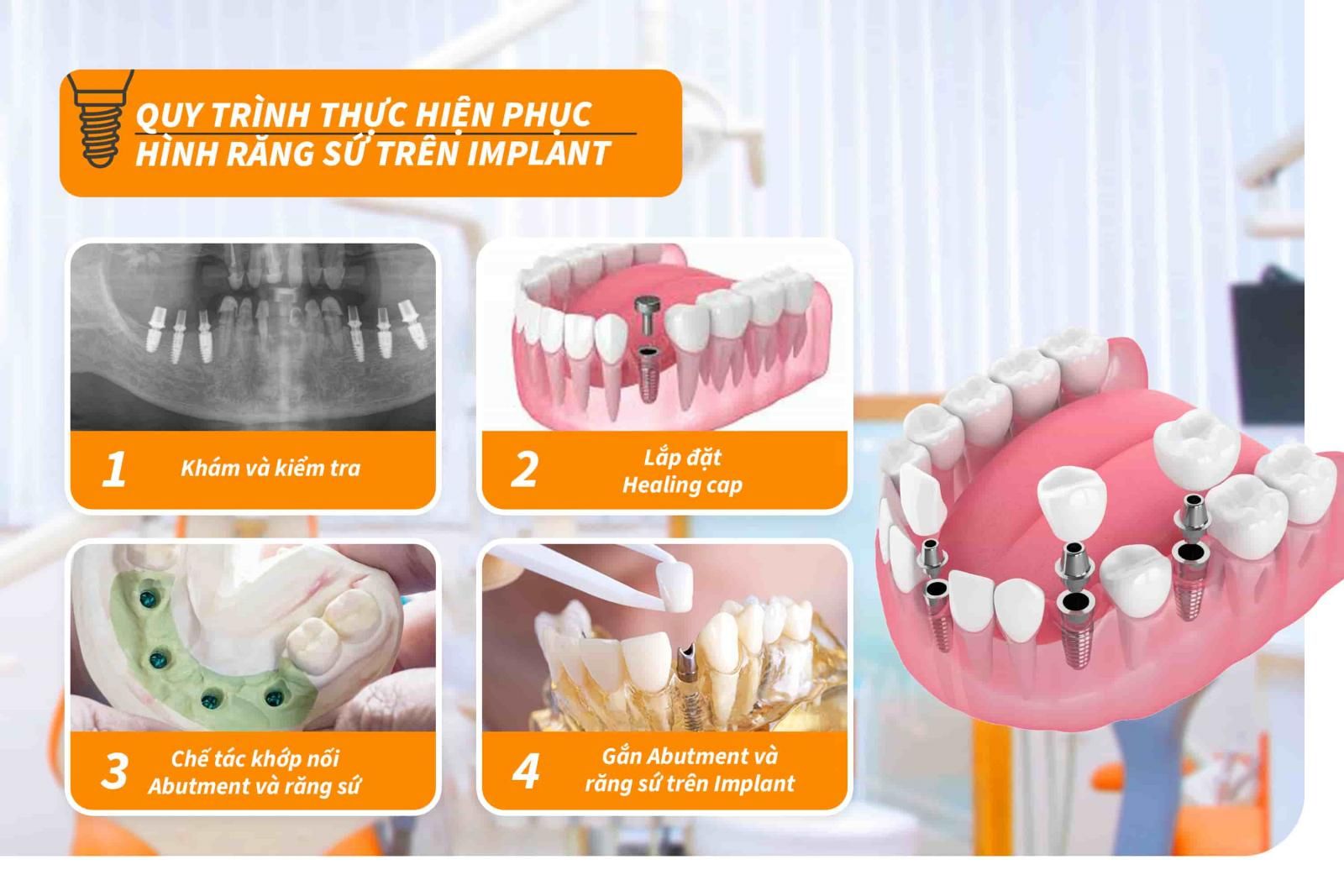 Quy trình phục hình sứ trên răng Implant