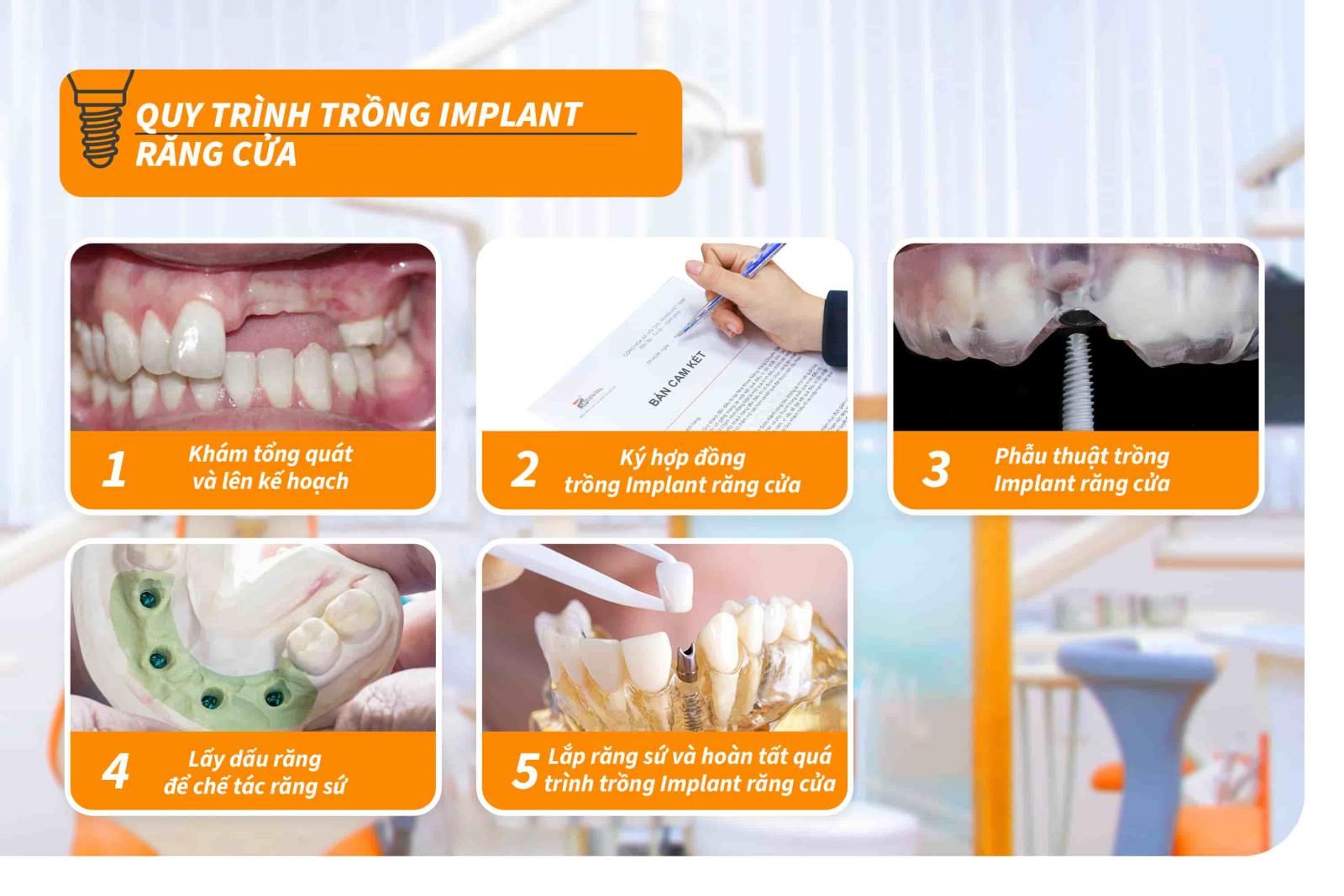 Quy trình trồng Implant răng cửa