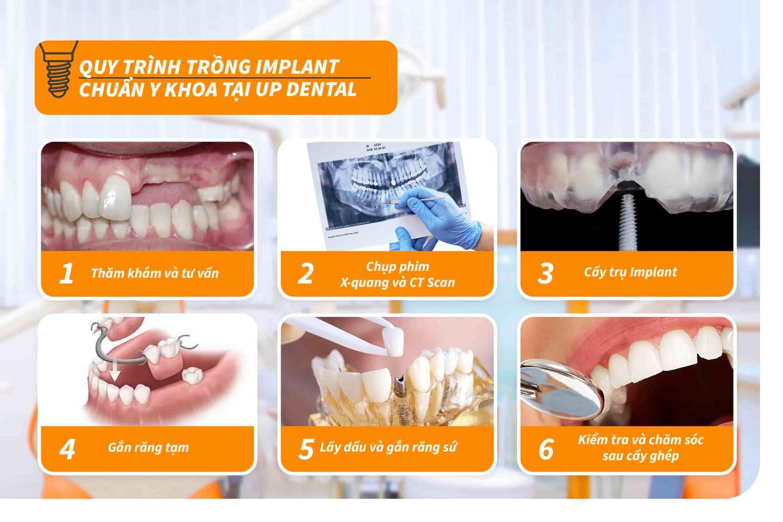 Quy trình trồng răng Implant chuẩn Y khoa tại Up Dental