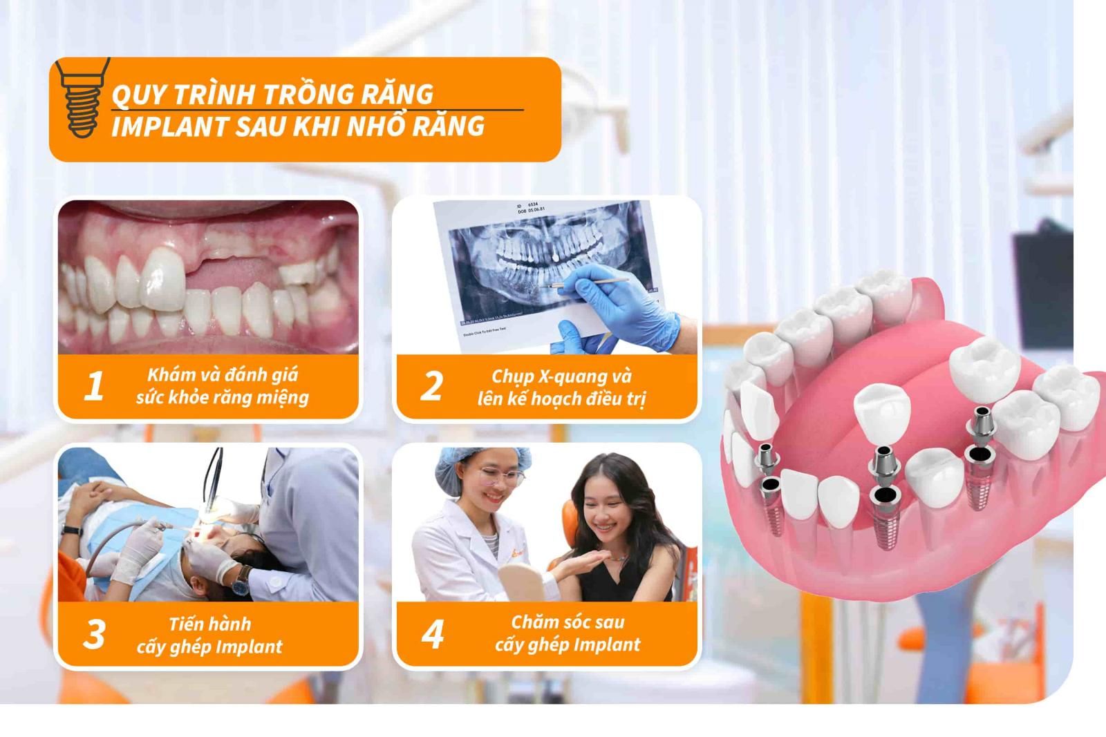 Quy trình trồng răng Implant sau khi nhổ