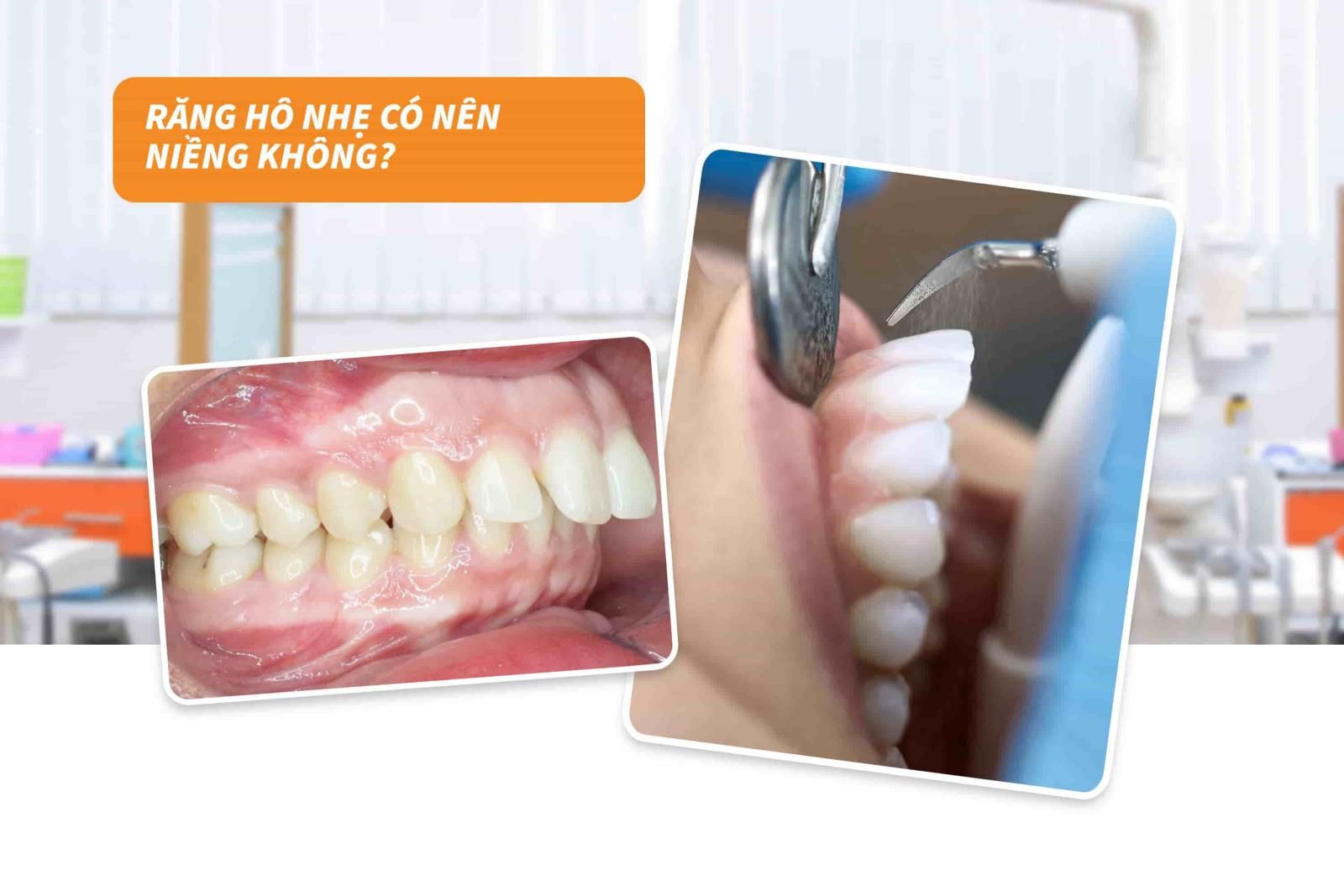 Răng hô nhẹ có nên niềng không?