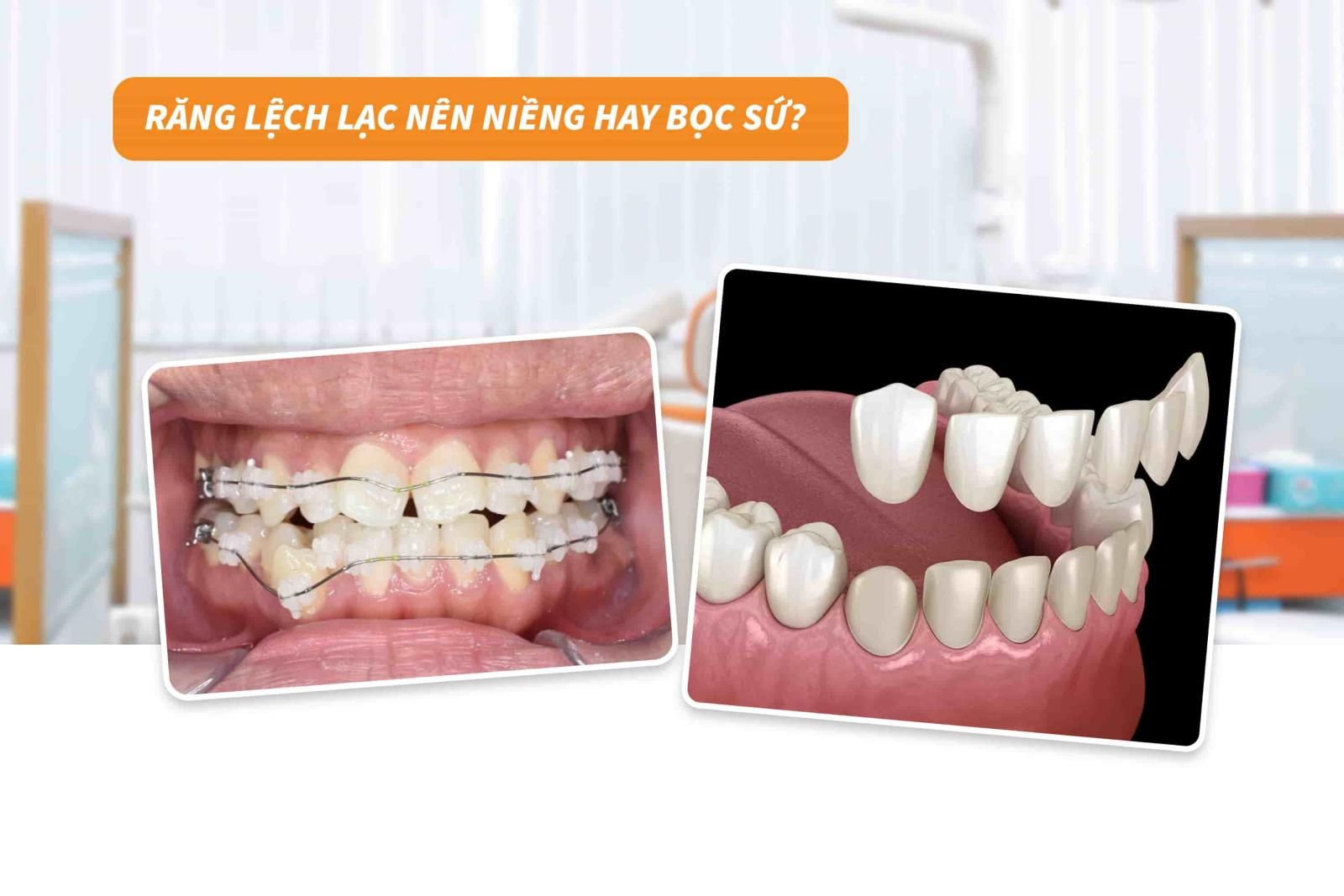 Răng lệch lạc nên niềng hay bọc sứ