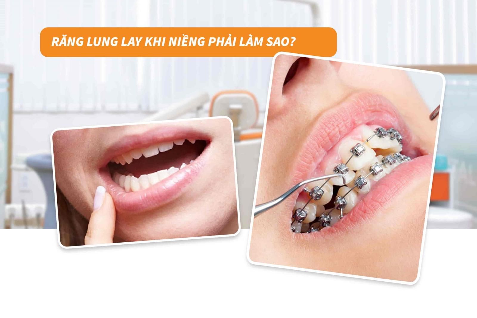 Răng lung lay khi niềng phải làm sao?