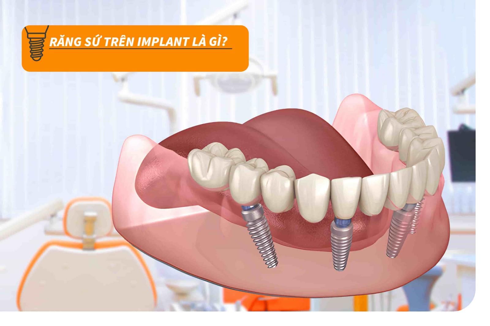 Răng sứ trên Implant là gì?