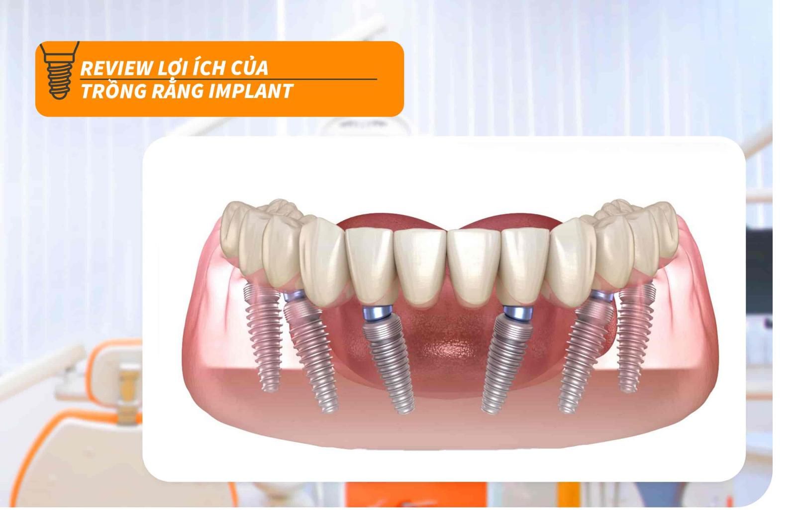 Review trồng răng Implant - Lợi ích mà răng trồng răng Implant mang lại