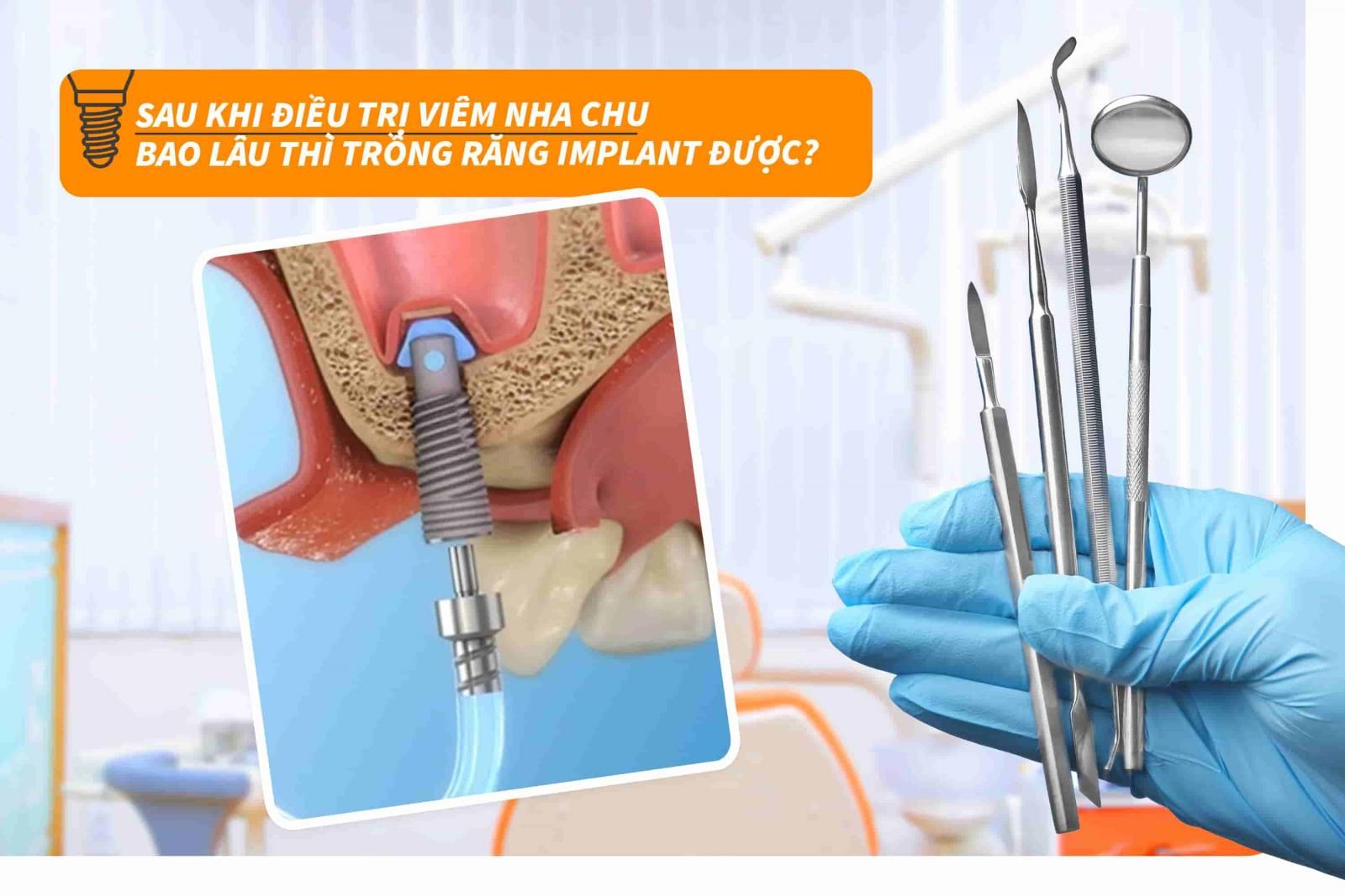 Sau khi điều trị viêm nha chu bao lâu thì trồng răng Implant được?