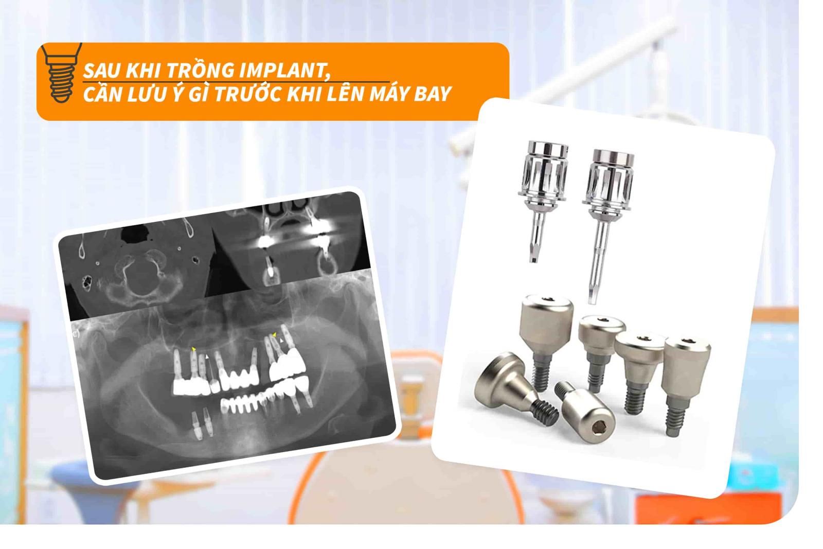 Sau khi trồng răng Implant, cần lưu ý gì trước khi lên máy bay