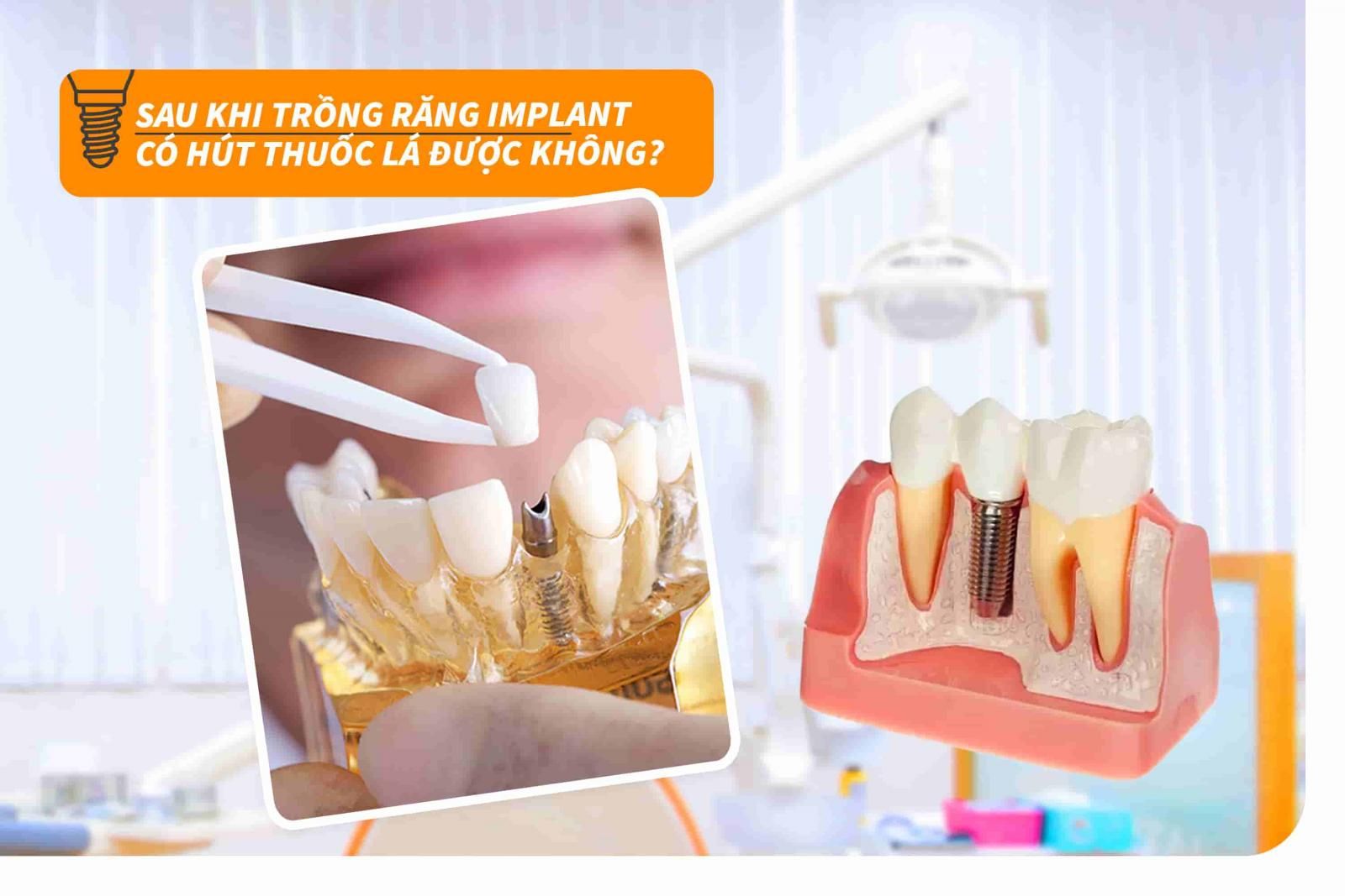 Sau khi trồng răng Implant có hút thuốc lá được không?