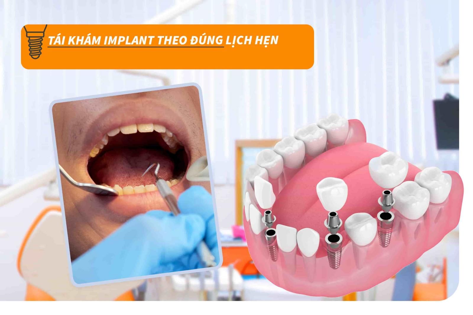 Tái khám Implant theo đúng lịch hẹn