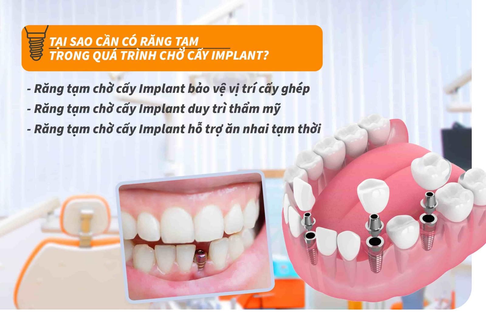 Tại sao cần có răng tạm trong quá trình chờ cấy Implant