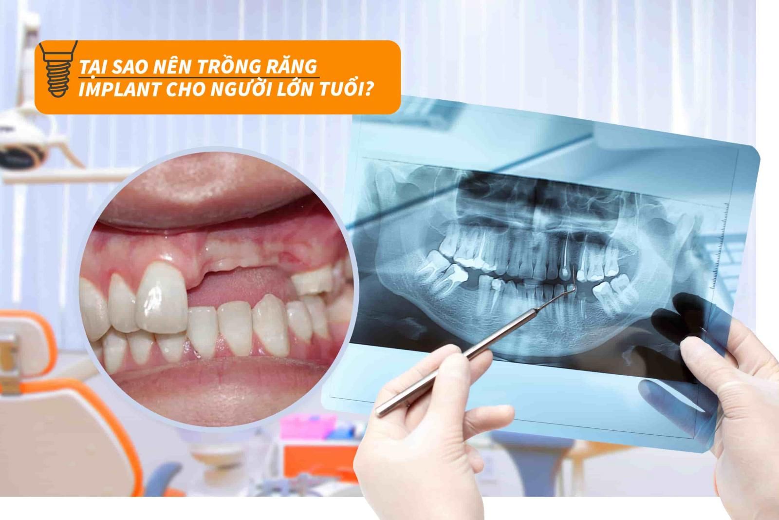 Tại sao nên trồng răng Implant cho người lớn tuổi