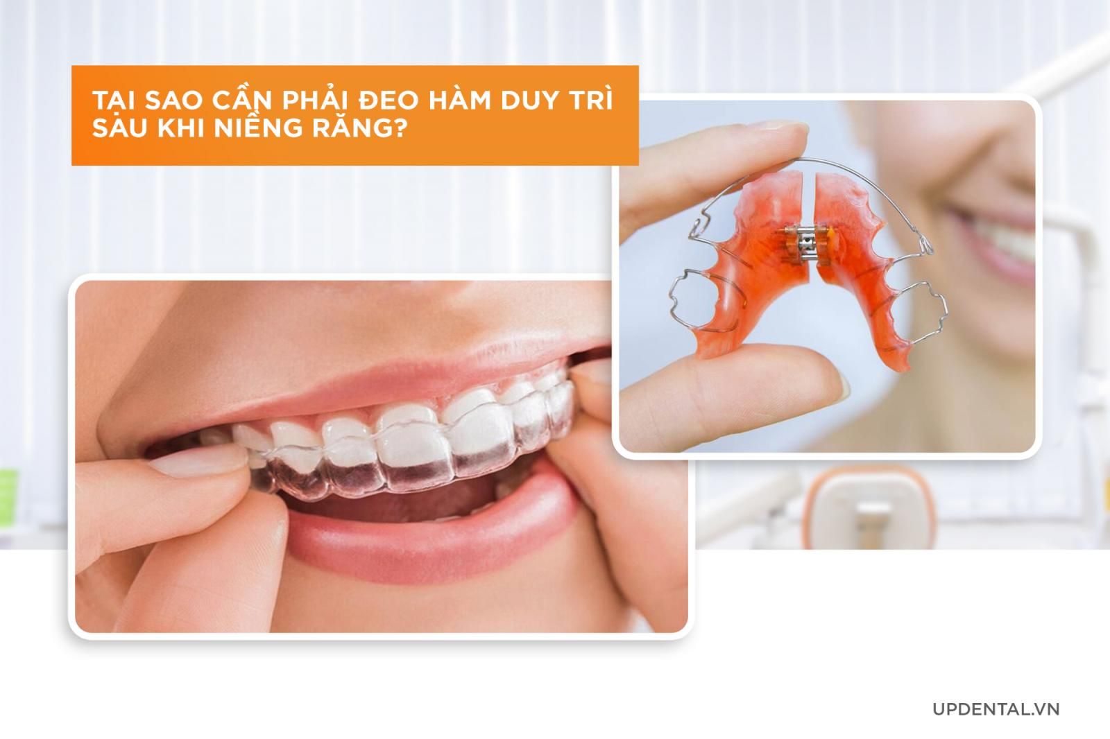 tại sao cần phải đeo hàm duy trì khi niềng răng