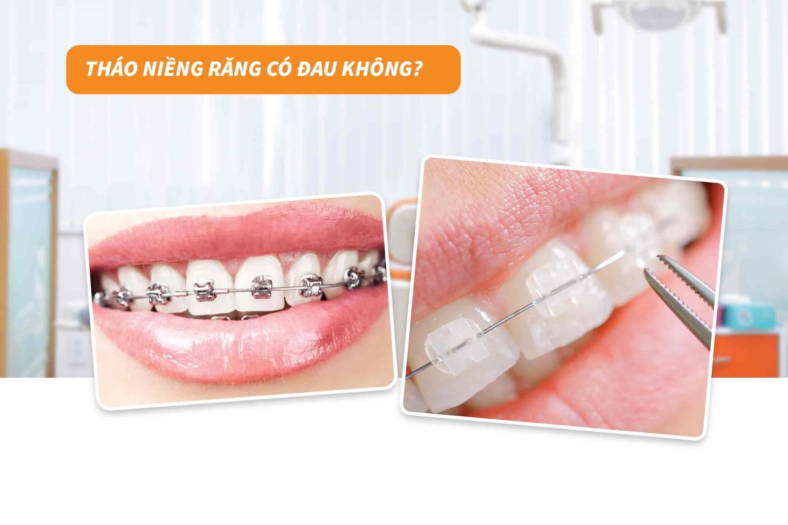 5. Các câu hỏi thường gặp khi tháo niềng răng