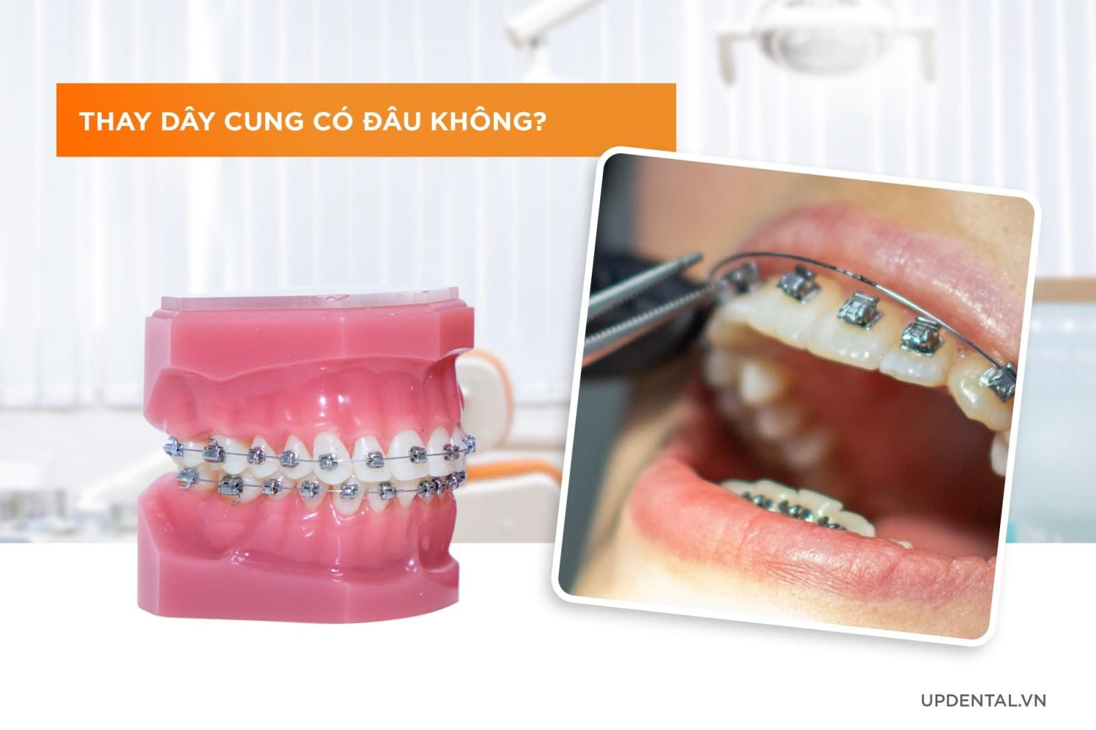 thay dây cung niềng răng có đau không