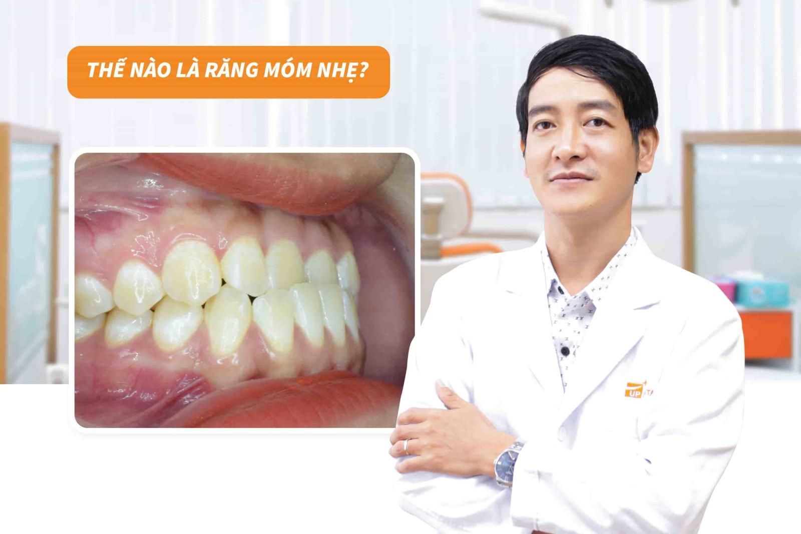 Thế nào là răng móm nhẹ