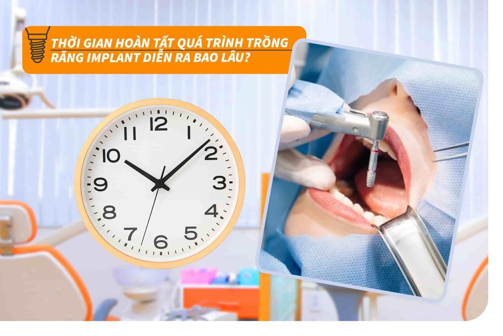 Thời gian hoàn tất quá trình trồng răng Implant diễ ra bao lâu?