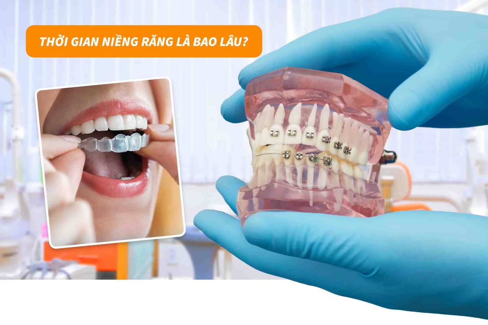 Thời gian niềng răng là bao lâu