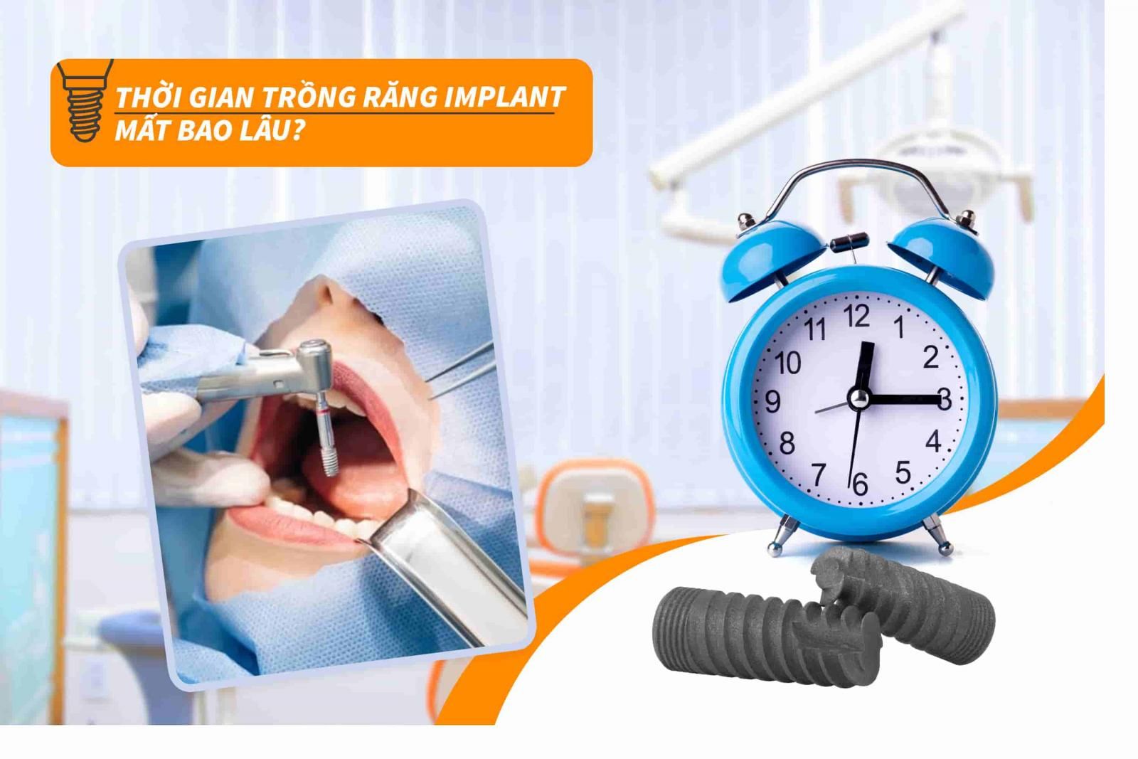 Thời gian trồng răng Implant mất bao lâu?