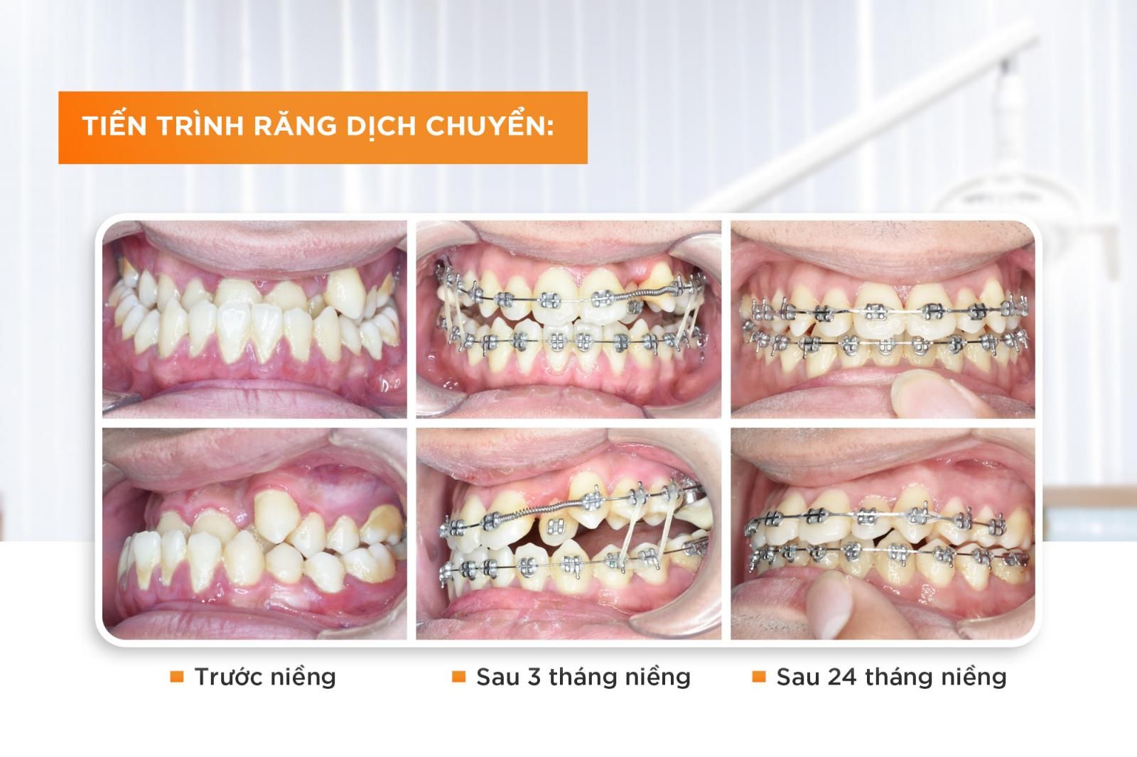 tiến trình dịch chuyển răng khi niềng