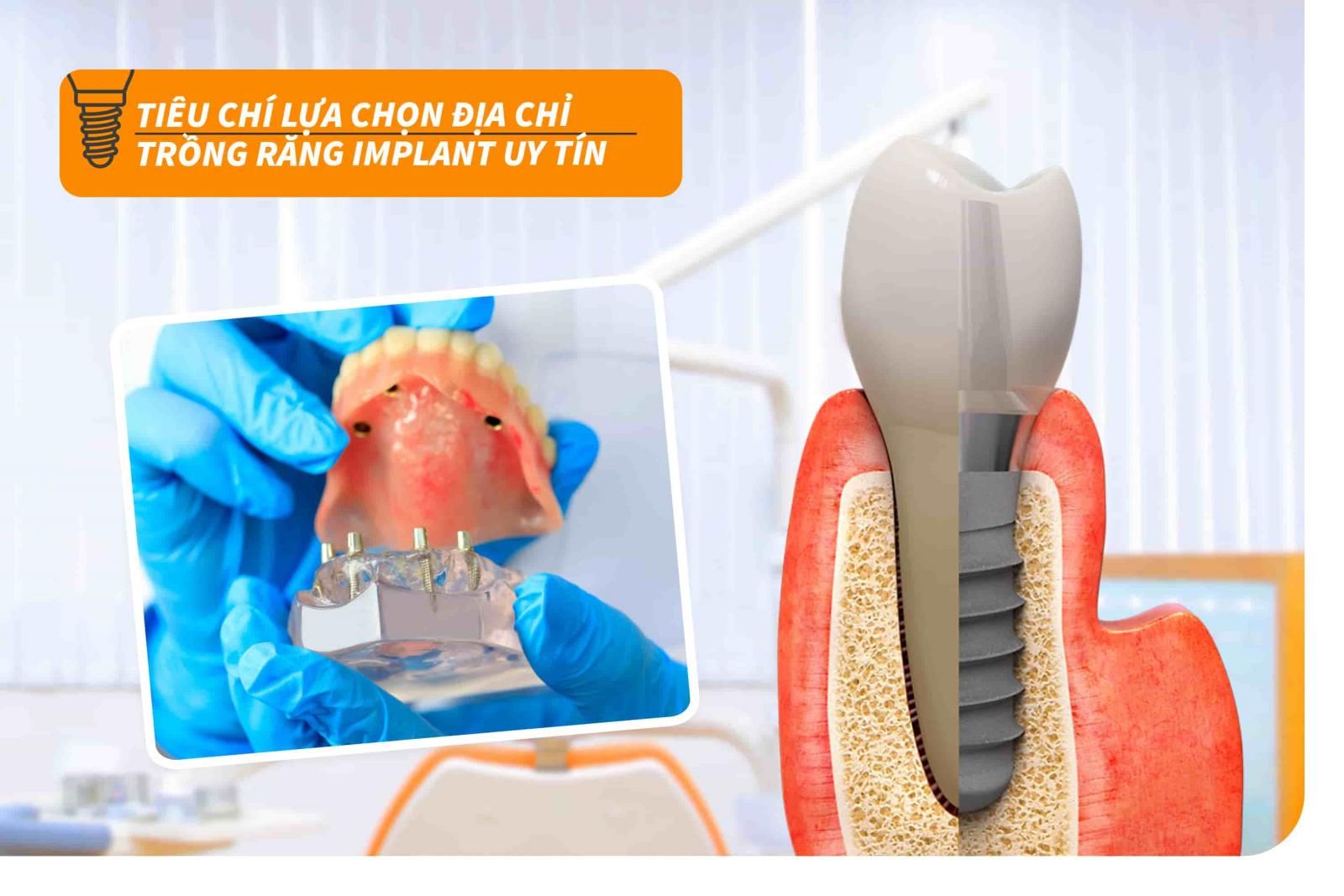 Tiêu chí lựa chọn địa chỉ trồng răng Implant uy tín