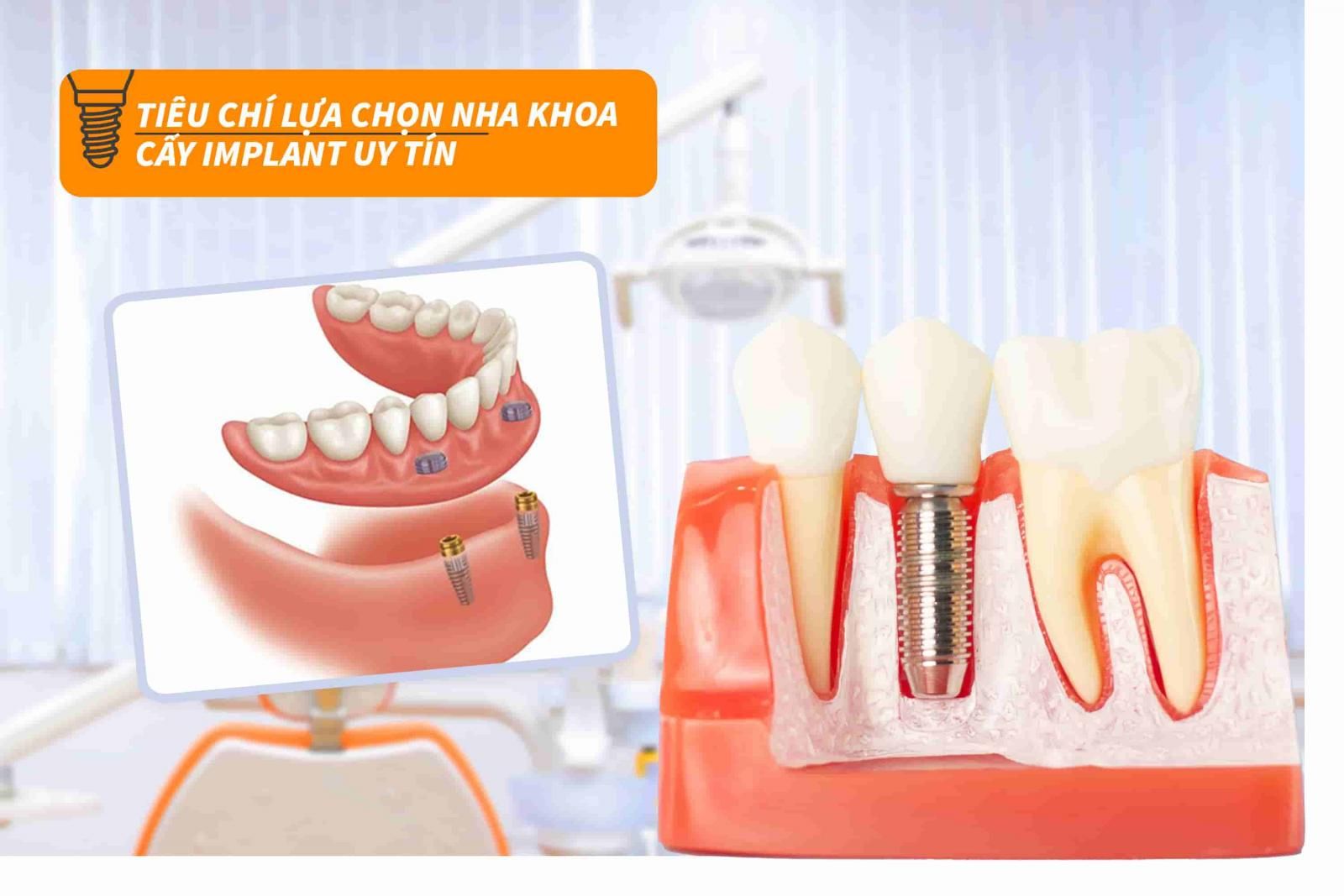 Tiêu chí lựa chọn nha khoa cấy Implant uy tín