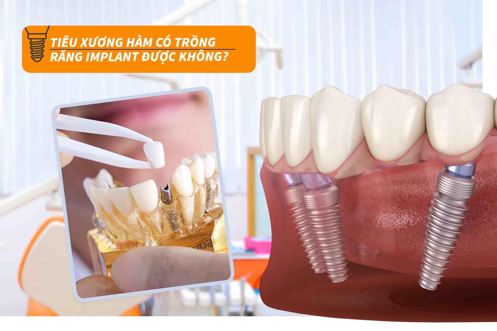 Tiêu xương hàm có trồng răng Implant được không?