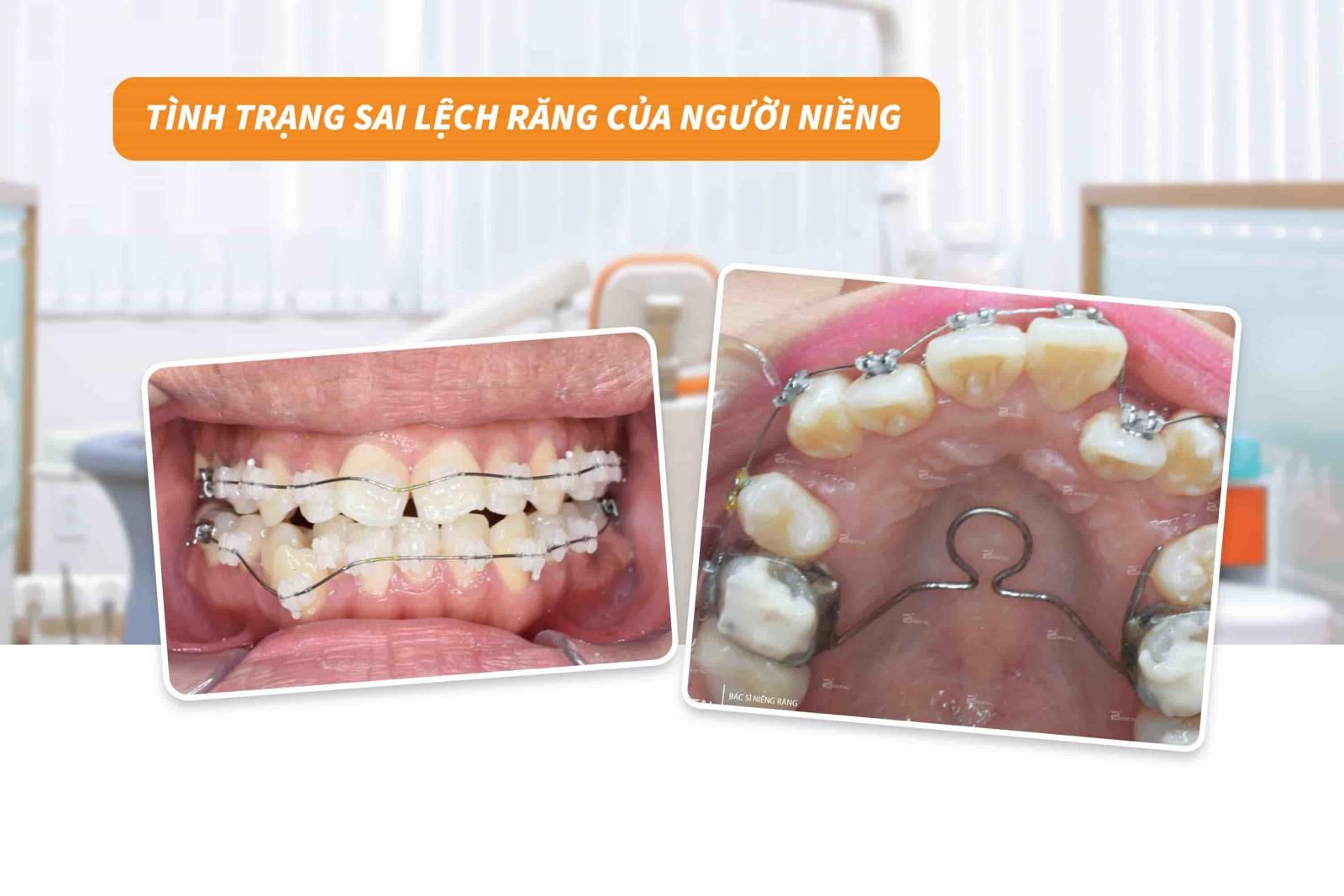 Tình trạng sai lệch răng của người niềng