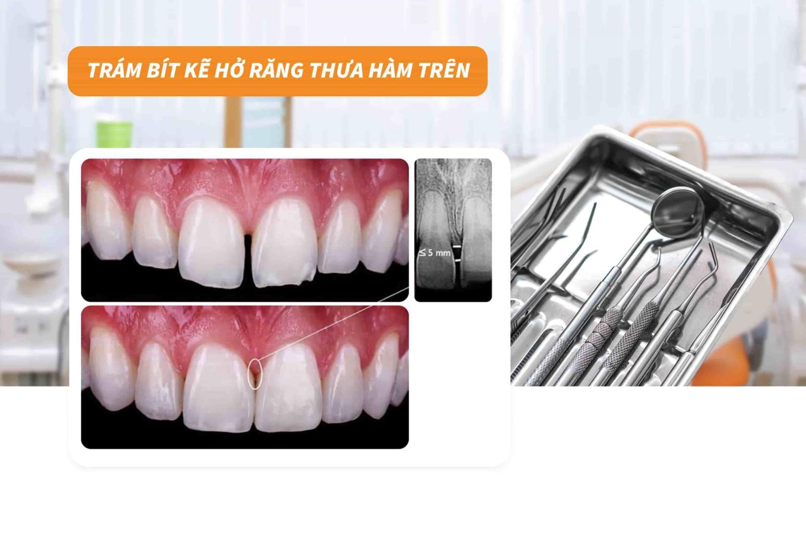 Trám bít kẽ hở răng thưa hàm trên