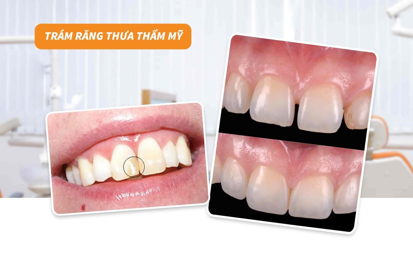 Trám răng thưa thẩm mỹ