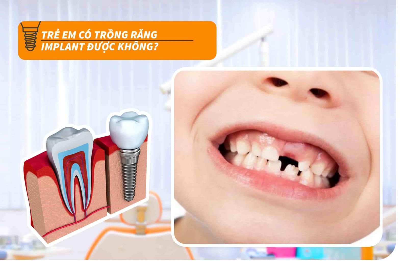 Trẻ em có trồng răng Implant được không?