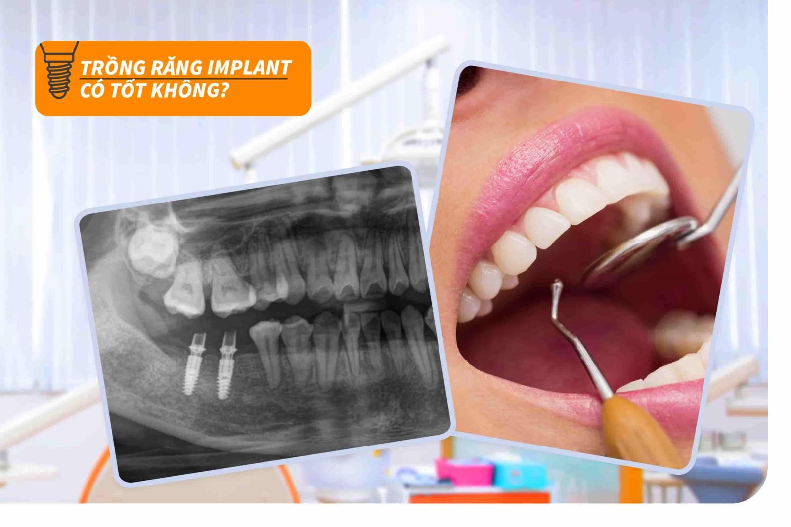 Trồng răng Implant có tốt không?