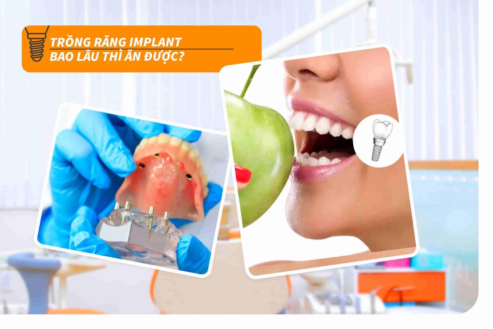 Trồng răng Implant bao lâu thì ăn được?