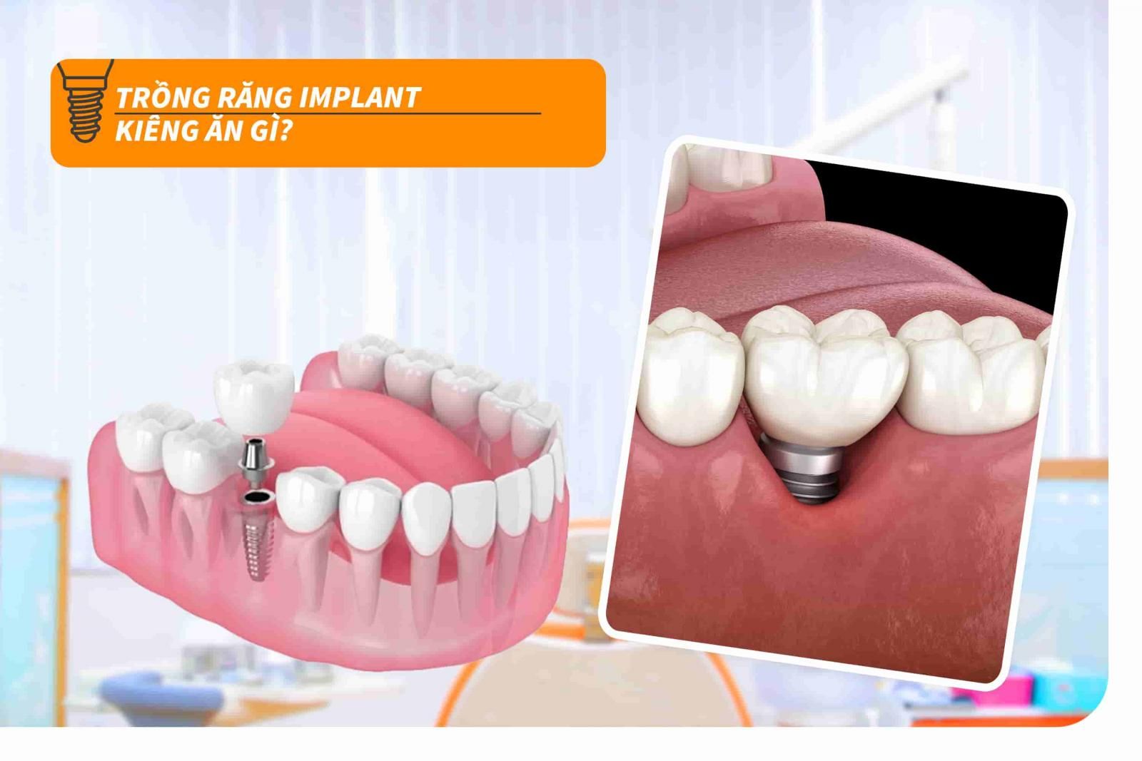 Trồng răng Implant kiêng ăn gì?