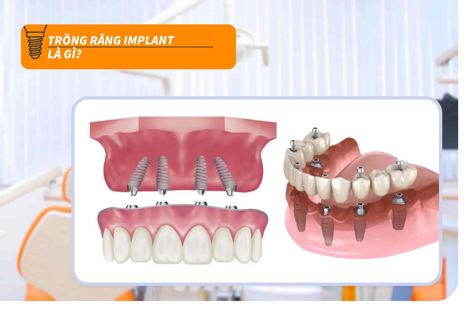 Trồng răng Implant là gì?