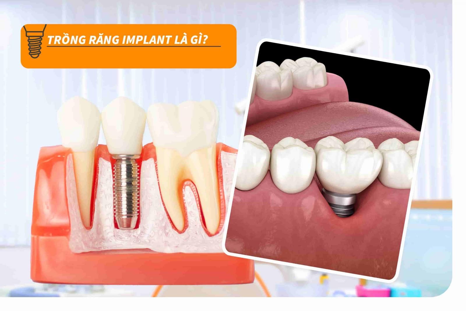 Trồng răng Implant là gì?