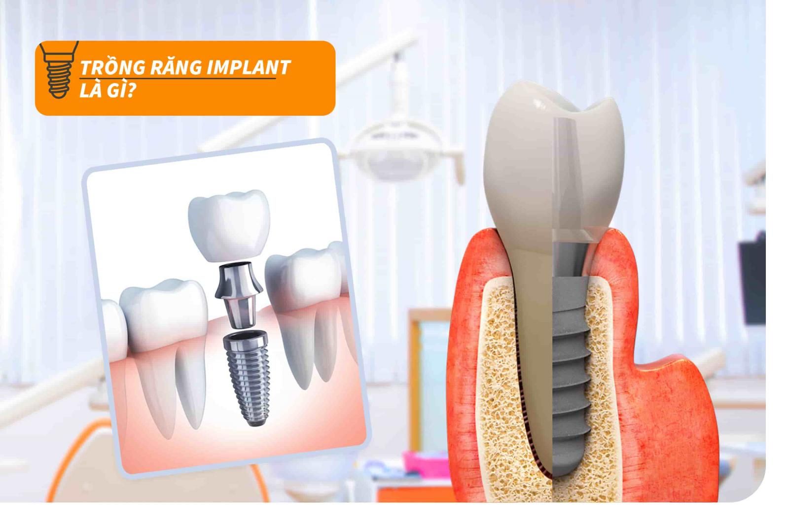 Trồng răng Implant là gì?