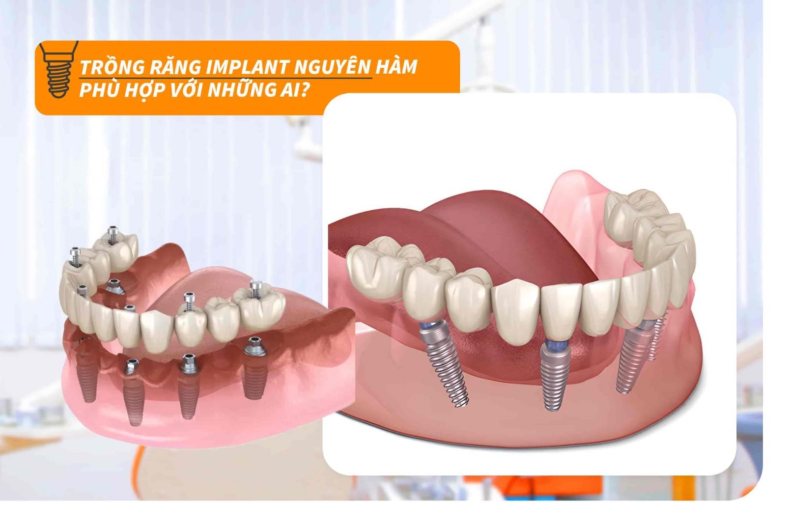 Trồng răng Implant nguyên hàm phù hợp với những ai