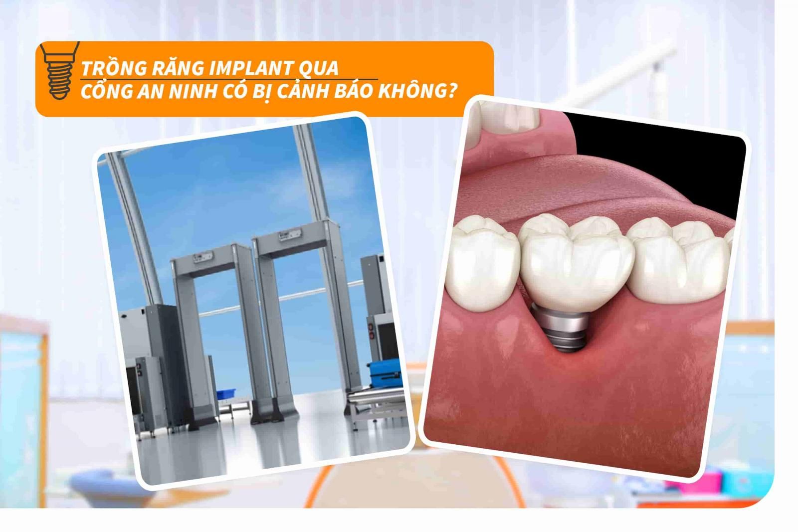 Trồng răng Implant qua cổng an ninh có bị cảnh báo không?