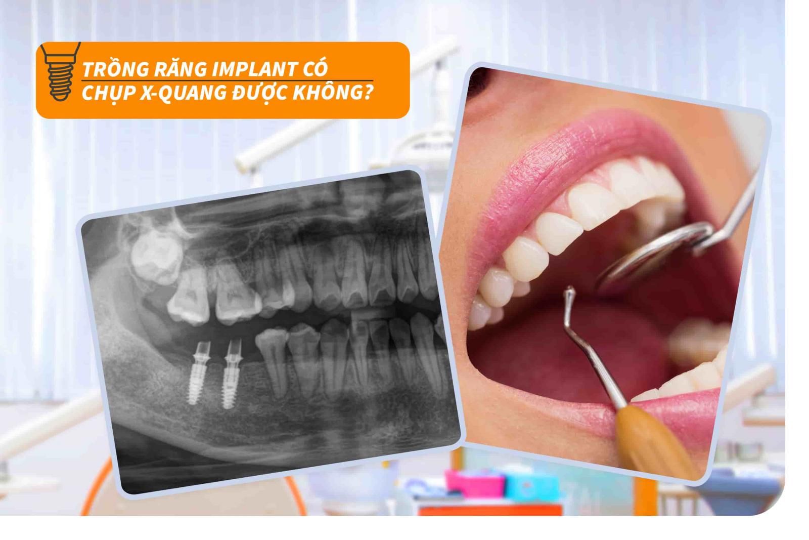 Trồng răng Implant có chụp X-quang được không?