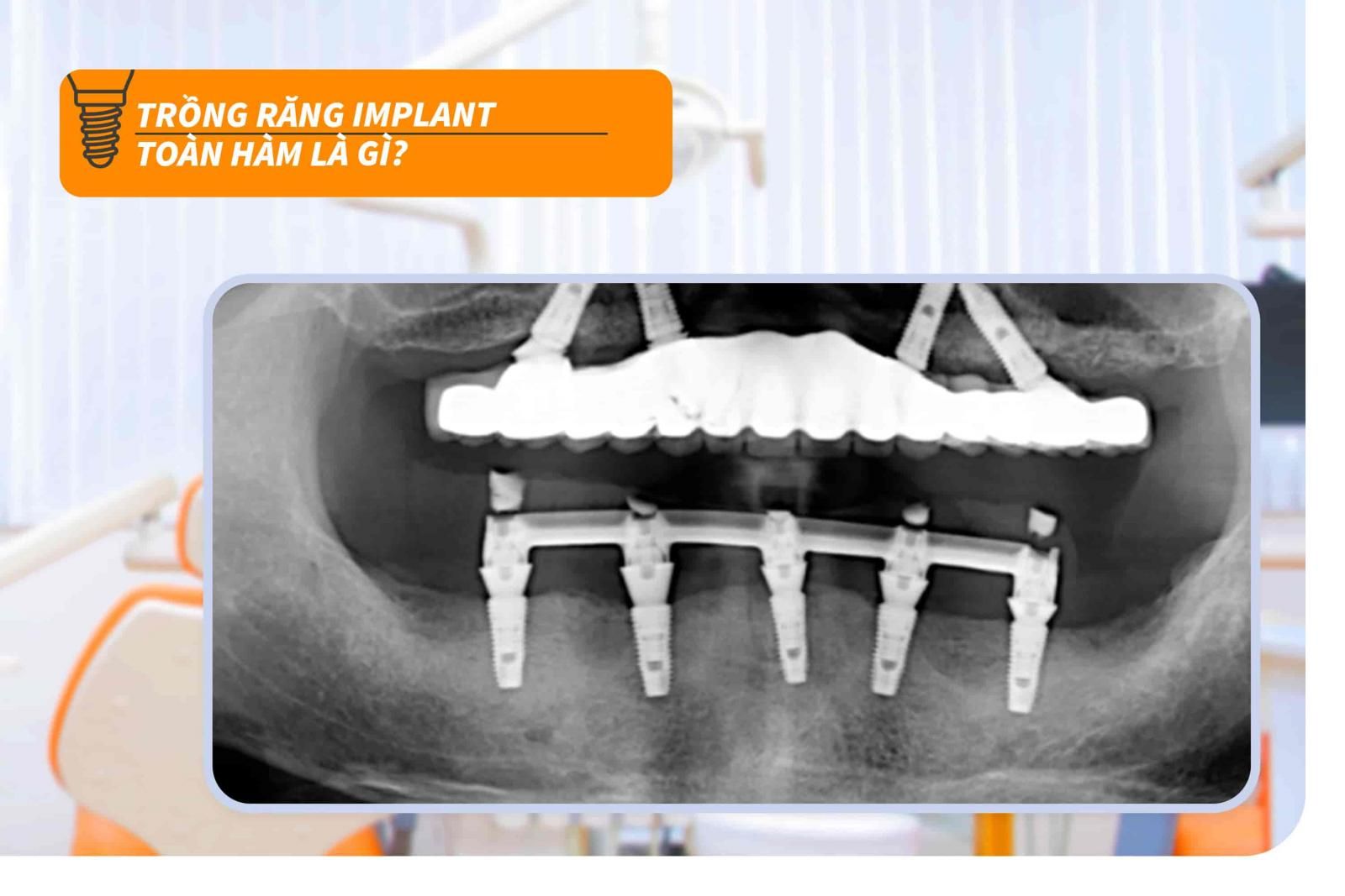 Trồng răng Implant toàn hàm là gì?