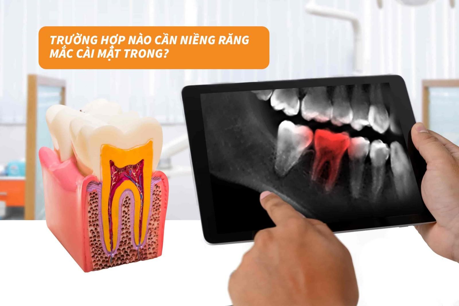 Trường hợp nào cần niềng răng mắc cài mặt trong