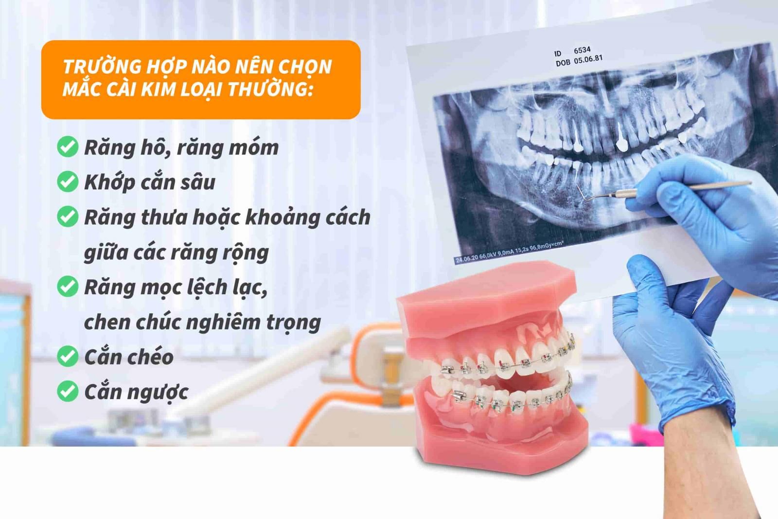 Trường hợp nào nên chọn mắc cài kim loại thường