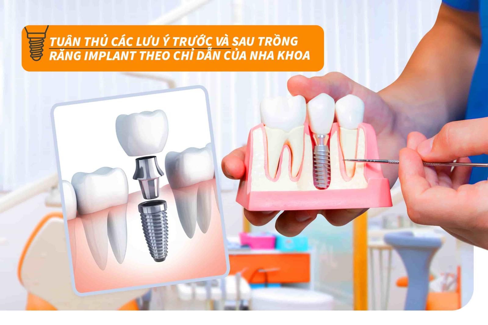 Tuân thủ các lưu ý trước và sau trồng răng Implant theo chỉ dẫn của nha khoa