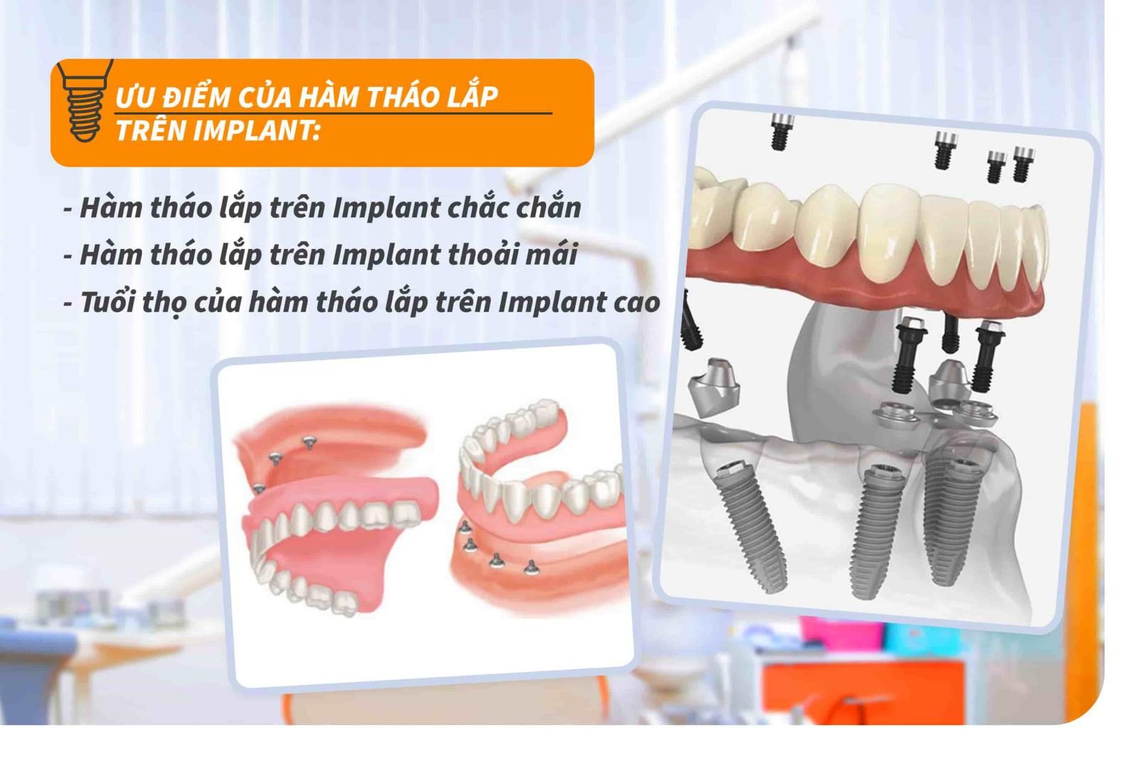 Ưu điểm của hàm tháo lắp trên Implant