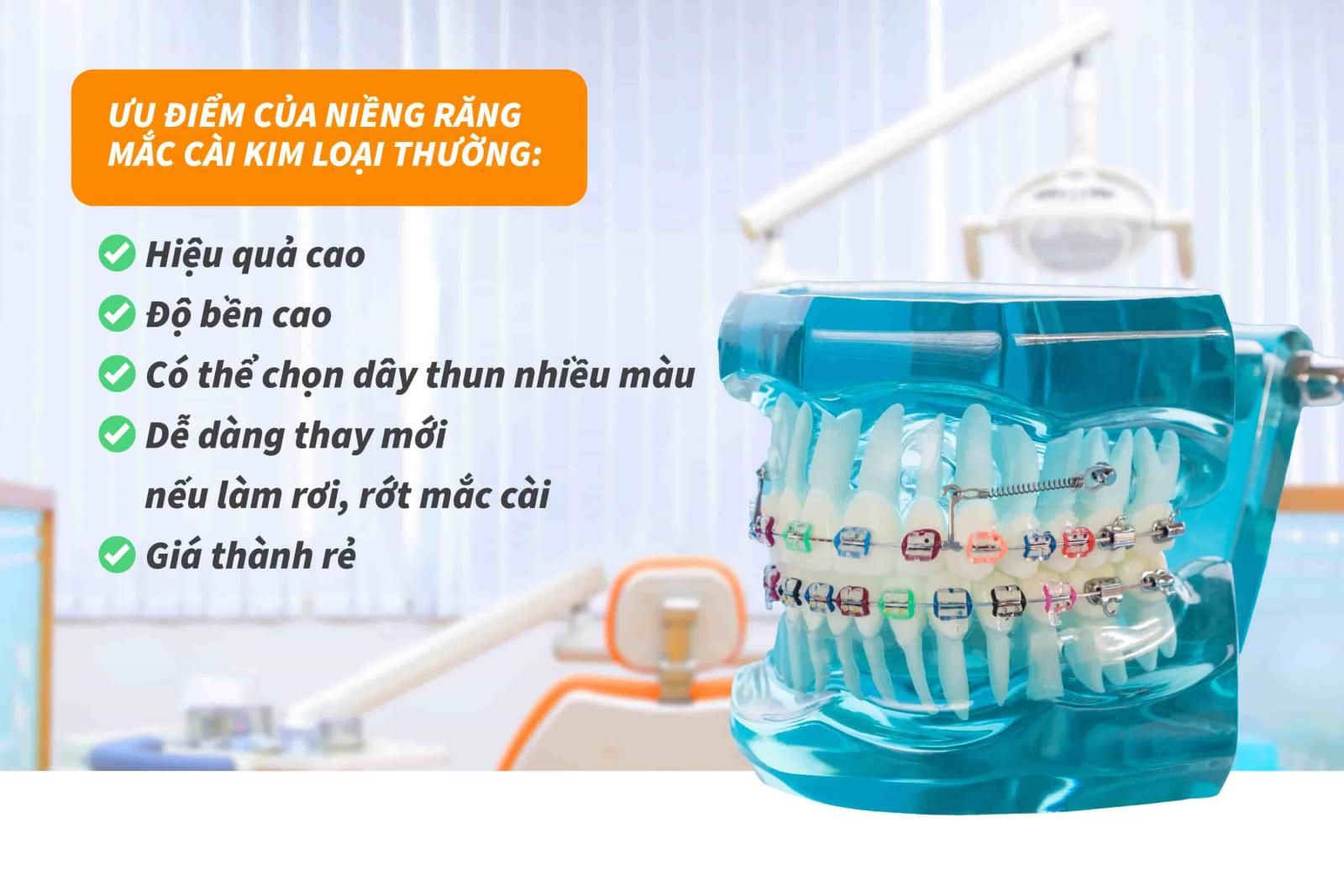 Ưu điểm của niềng răng mắc cài kim loại thường