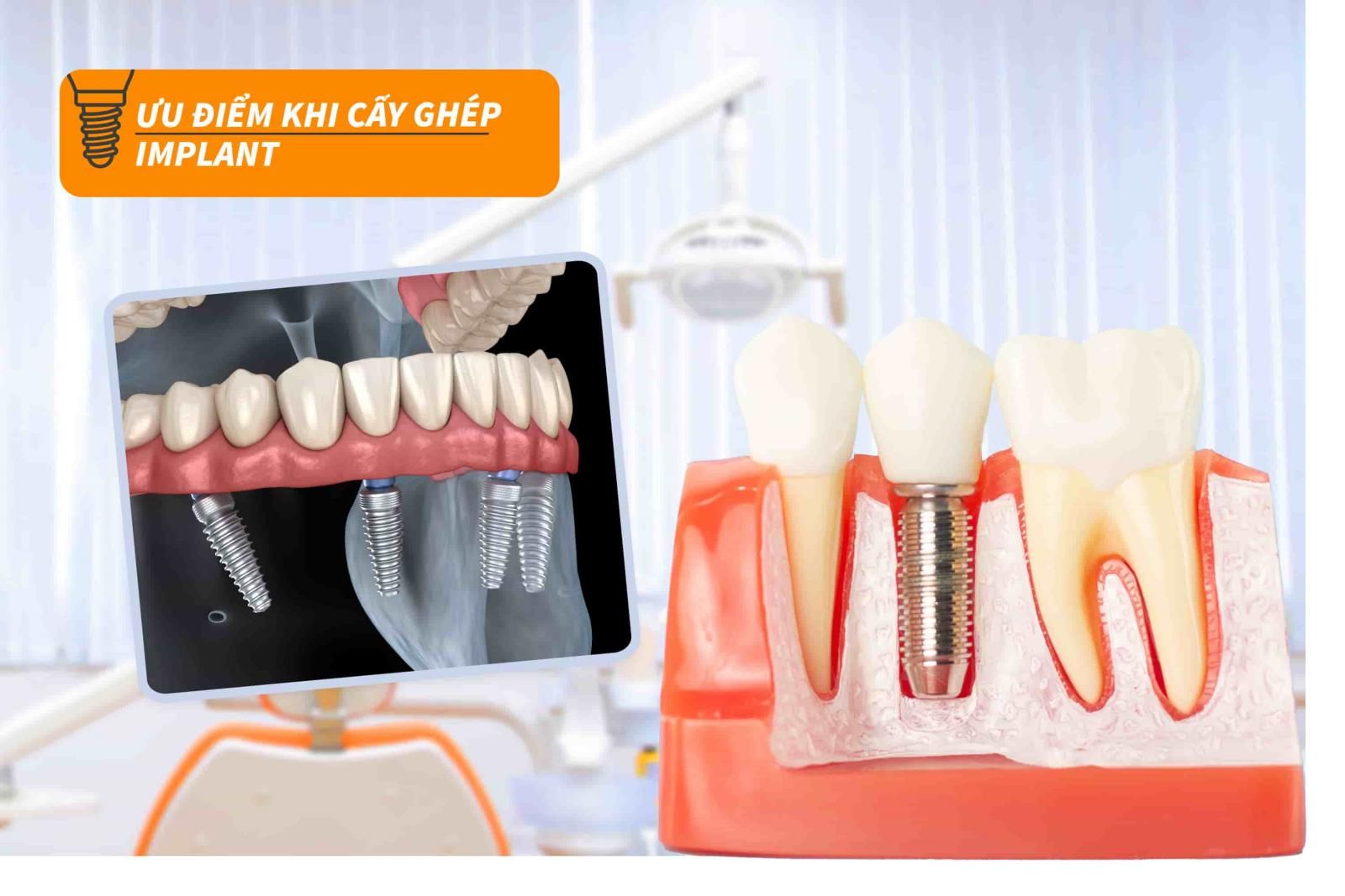 Ưu điểm của trồng răng Implant